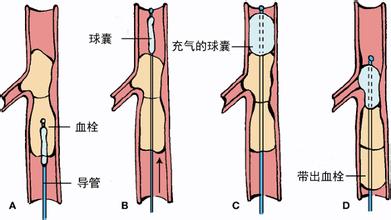 Forgarty球囊导管取栓术操作过程